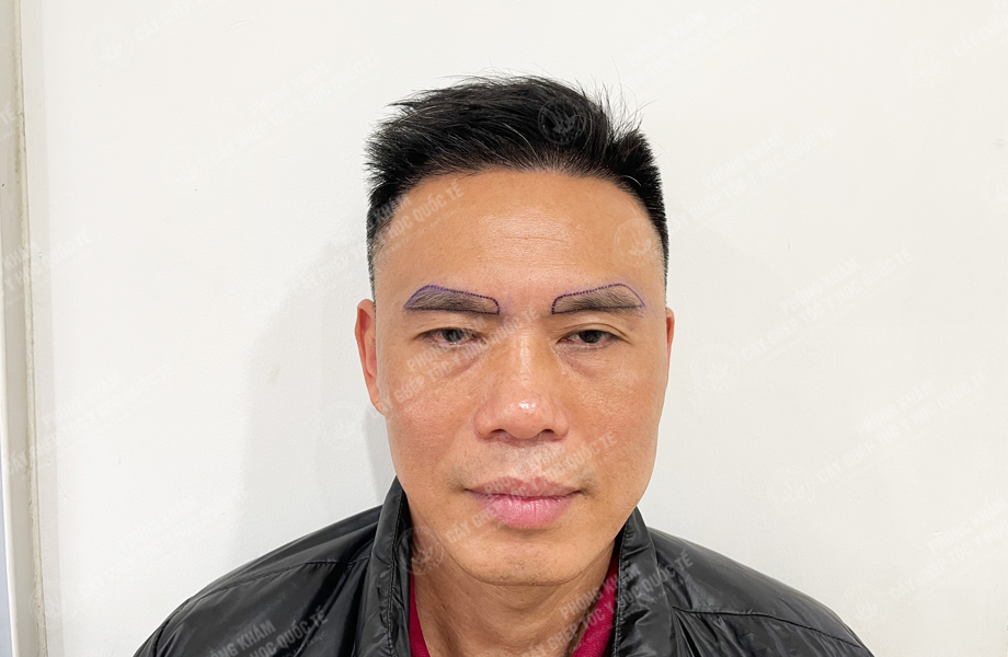 Đào Văn Minh - Cấy tóc đường chữ M 6