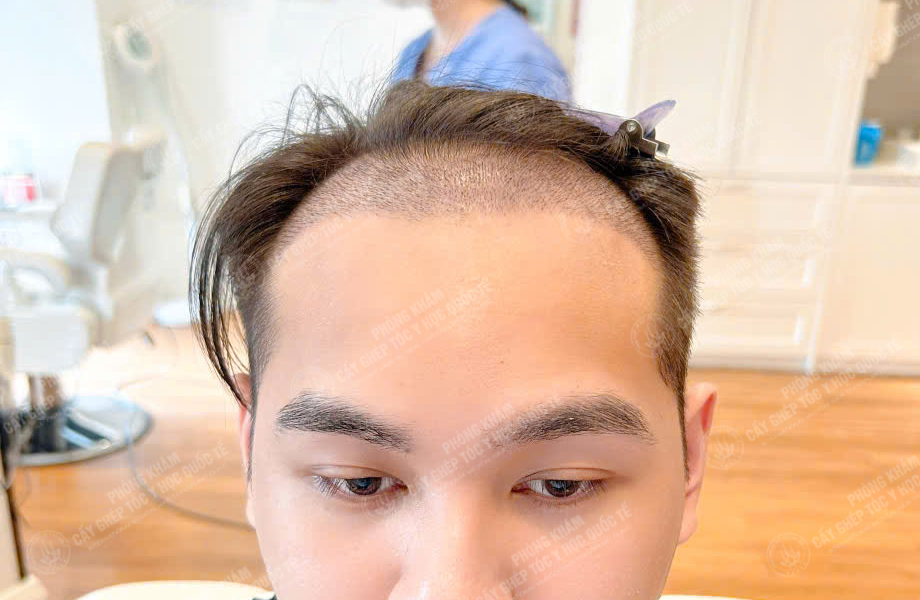 Nguyễn Minh Quân - Cấy tóc đường chữ M 6