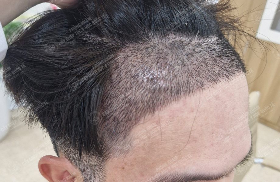 Nguyễn Hoàng Hưng - Cấy tóc đường chữ M 6