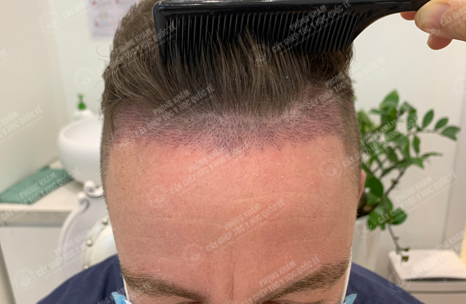 Jay Son - Cấy tóc đường chữ M 6