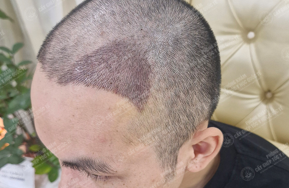 Đỗ Thanh Nhân - Cấy tóc đường chữ M 6