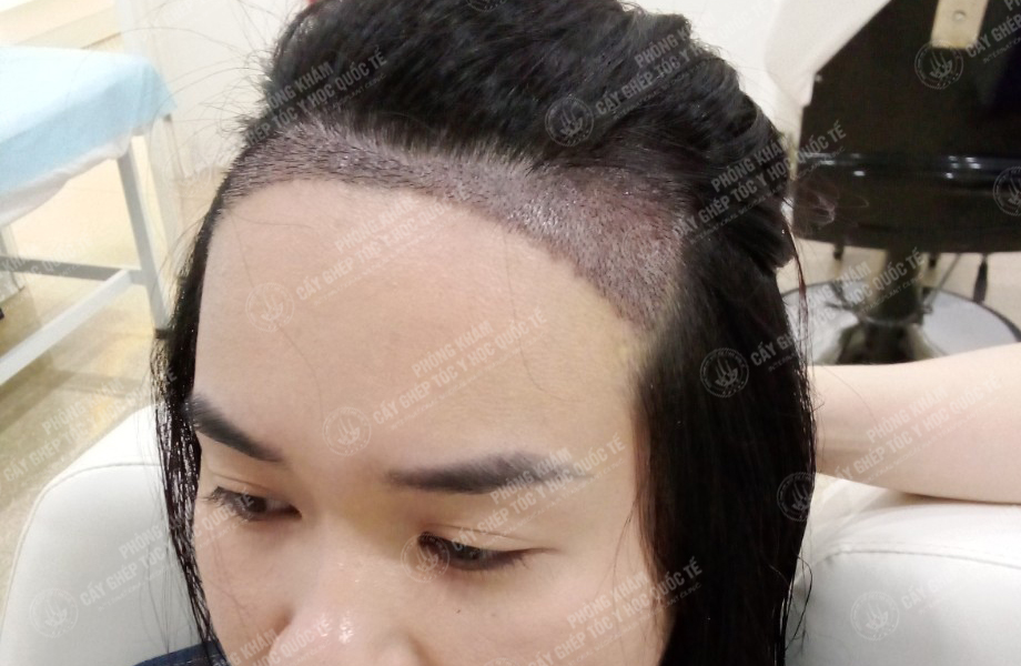 Đỗ Thị Hạnh - Cấy tóc đường chữ M 6