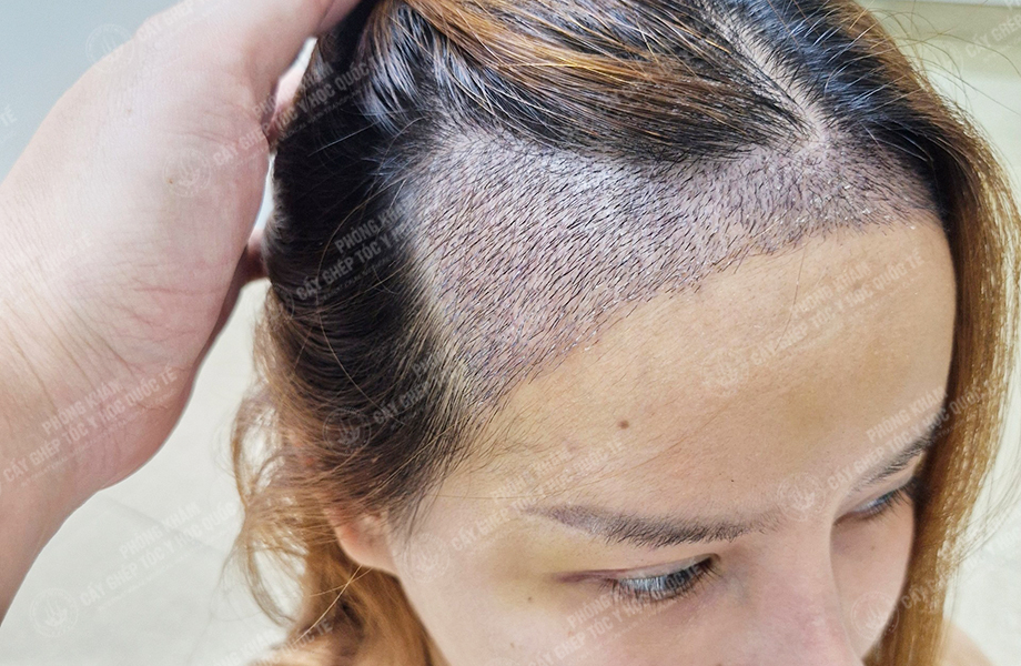 Ngô Thị Hồng - Cấy tóc đường chữ M 6