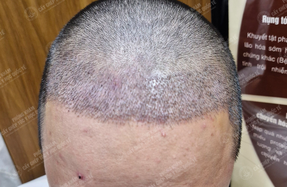 Lê Thanh Ngọc - Cấy tóc đường chữ M 6