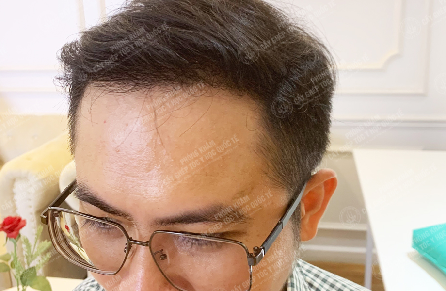 Bùi Văn Lanh - Cấy tóc đường chữ M 7