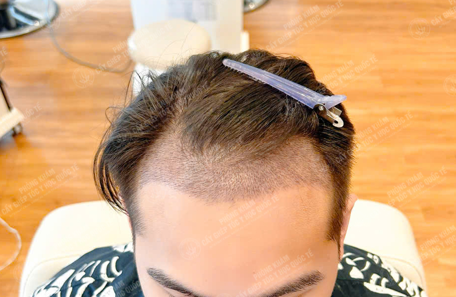 Nguyễn Minh Quân - Cấy tóc đường chữ M 7