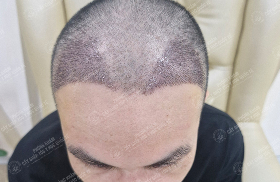 Đỗ Thanh Nhân - Cấy tóc đường chữ M 7