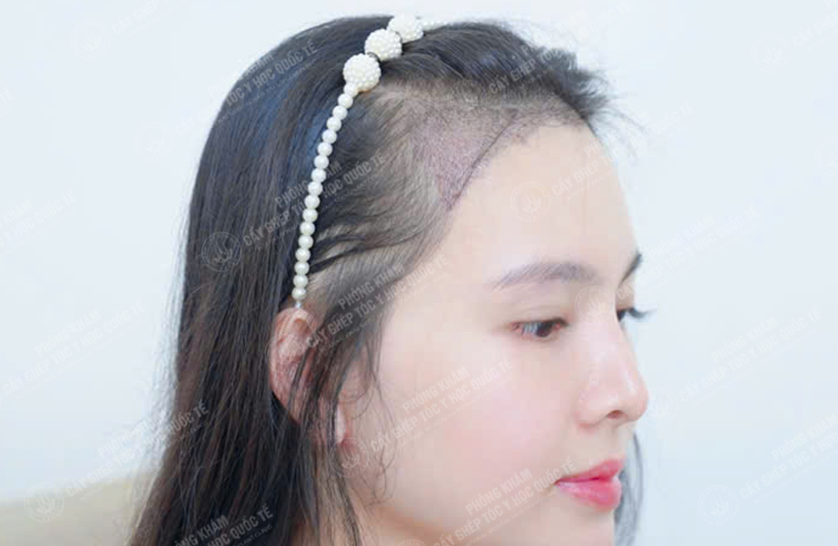 Đào Thị Phương - Cấy tóc đường chữ M 7