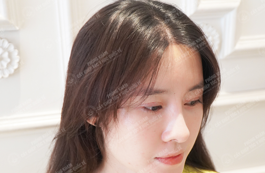 Nguyễn Ngọc Ngà - Cấy tóc tự thân 7