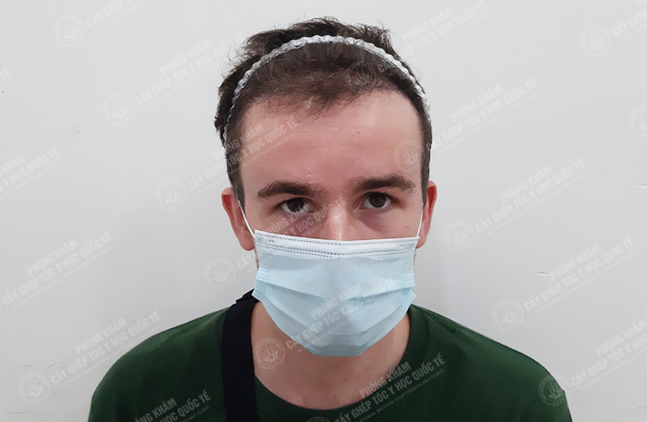 Leo Parry - Cấy tóc đường chữ M 7