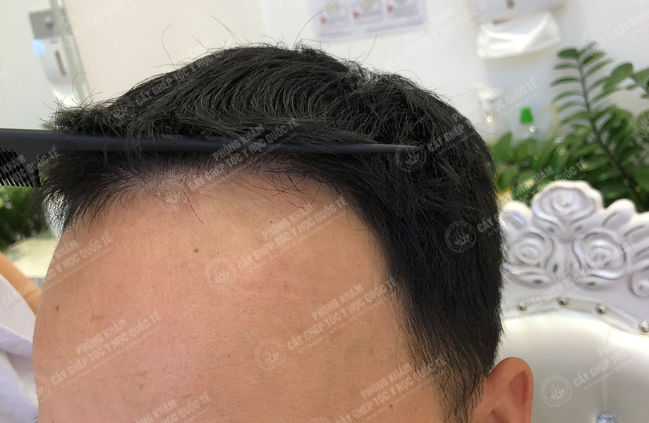 Hoàng Thái Sơn - Cấy tóc đường chữ M 7