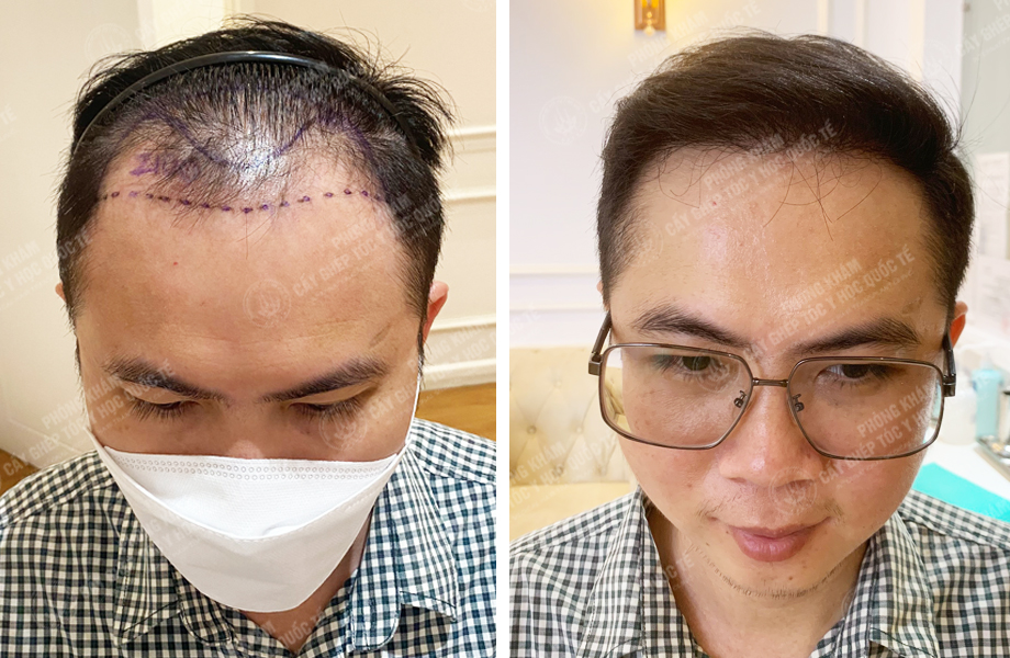  Bùi Văn Lanh - Cấy tóc tự thân 1