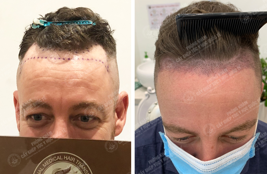  JAME SON - Cấy tóc tự thân 1