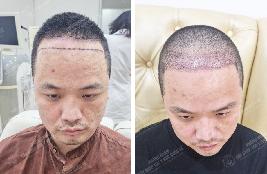  Lê Thanh Ngọc - Cấy tóc tự thân 1
