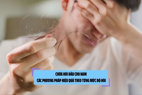 Chữa hói đầu cho nam: Các phương pháp hiệu quả theo từng mức độ hói