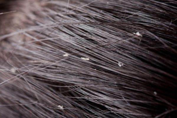 TOP 10 Cách trị gàu ống đơn giản tại nhà giúp sạch gàu hiệu quả
