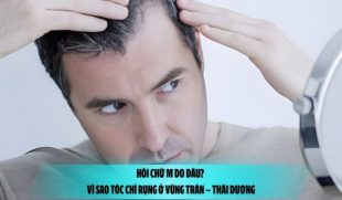 Hói chữ M do đâu? Vì sao tóc chỉ rụng ở vùng trán – thái dương