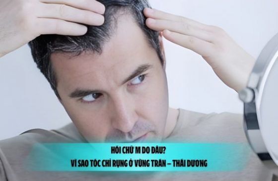 Hói chữ M do đâu? Vì sao tóc chỉ rụng ở vùng trán – thái dương