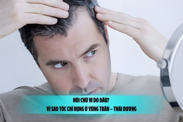 Hói chữ M do đâu? Vì sao tóc chỉ rụng ở vùng trán – thái dương