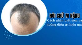 Hói chữ M nặng: Cách nhận biết sớm và hướng điều trị hiệu quả