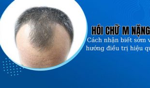 Hói chữ M nặng: Cách nhận biết sớm và hướng điều trị hiệu quả
