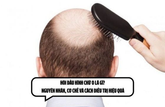 Hói đầu hình chữ O là gì? Nguyên nhân, cơ chế và cách điều trị hiệu quả