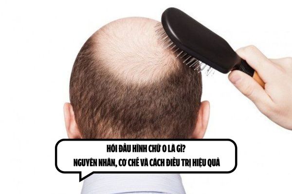 Hói đầu hình chữ O là gì? Nguyên nhân, cơ chế và cách điều trị hiệu quả
