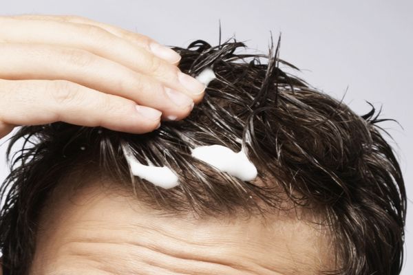 Kiểu tóc trán hói chữ M: Gợi ý giúp che khuyết điểm và cải thiện diện mạo