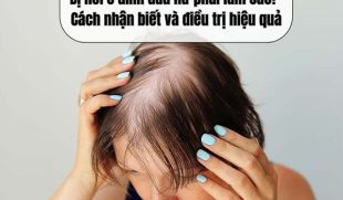 Bị hói ở đỉnh đầu nữ phải làm sao? Cách nhận biết và điều trị hiệu quả