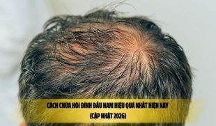 Cách chữa hói đỉnh đầu nam hiệu quả nhất hiện nay (Cập nhật 2026)