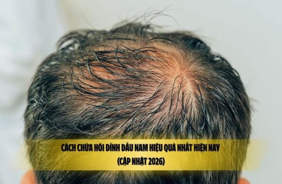 Cách chữa hói đỉnh đầu nam hiệu quả nhất hiện nay (Cập nhật 2026)