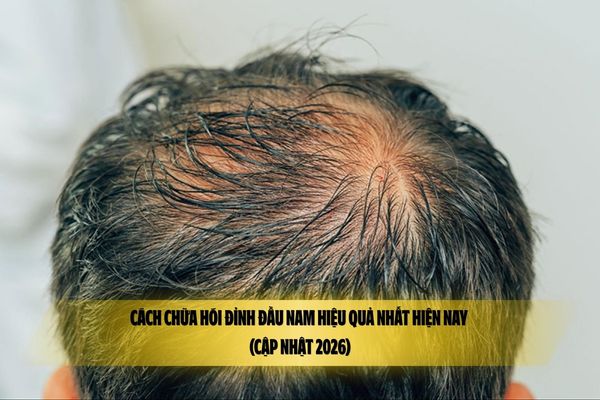 Cách chữa hói đỉnh đầu nam hiệu quả nhất hiện nay (Cập nhật 2026)