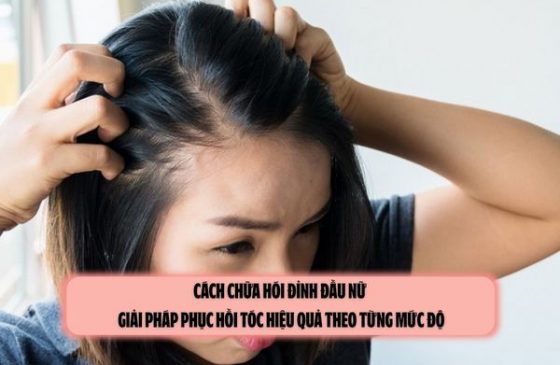 Cách chữa hói đỉnh đầu nữ: Giải pháp phục hồi tóc hiệu quả theo từng mức độ