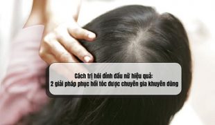 Cách trị hói đỉnh đầu nữ hiệu quả: 2 giải pháp phục hồi tóc được chuyên gia khuyên dùng