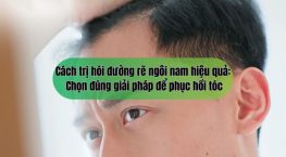 Cách trị hói đường rẽ ngôi nam hiệu quả: Chọn đúng giải pháp để phục hồi tóc