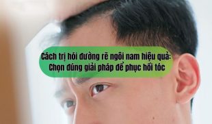 Cách trị hói đường rẽ ngôi nam hiệu quả: Chọn đúng giải pháp để phục hồi tóc