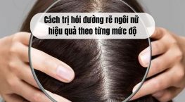 Cách trị hói đường rẽ ngôi nữ hiệu quả theo từng mức độ