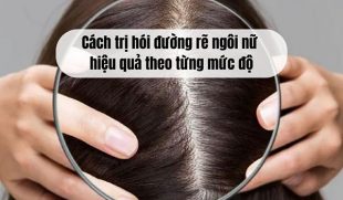Cách trị hói đường rẽ ngôi nữ hiệu quả theo từng mức độ