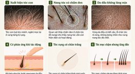 Dấu hiệu nang tóc còn sống: 6 Cách nhận biết chính xác