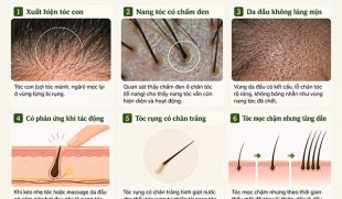 Dấu hiệu nang tóc còn sống: 6 Cách nhận biết chính xác
