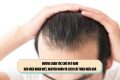 Đường chân tóc chữ M ở nam: Dấu hiệu nhận biết, nguyên nhân và cách cải thiện hiệu quả