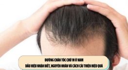 Đường chân tóc chữ M ở nam: Dấu hiệu nhận biết, nguyên nhân và cách cải thiện hiệu quả