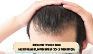 Đường chân tóc chữ M ở nam: Dấu hiệu nhận biết, nguyên nhân và cách cải thiện hiệu quả