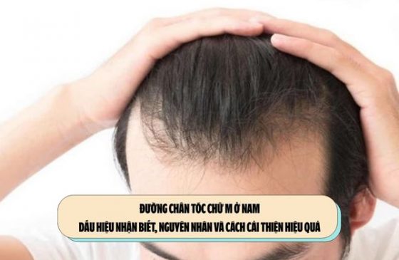 Đường chân tóc chữ M ở nam: Dấu hiệu nhận biết, nguyên nhân và cách cải thiện hiệu quả