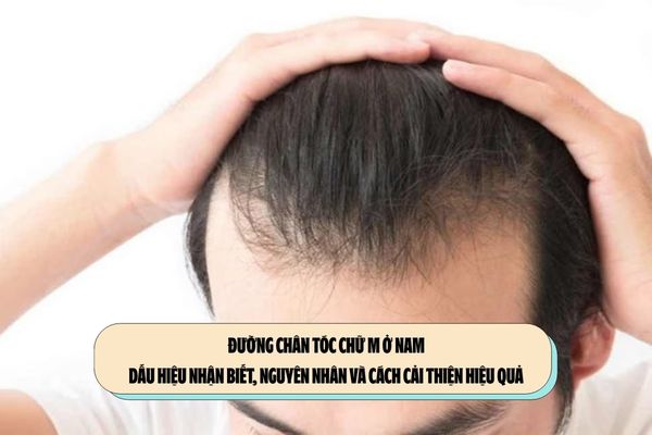 Đường chân tóc chữ M ở nam: Dấu hiệu nhận biết, nguyên nhân và cách cải thiện hiệu quả