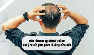 Kiểu tóc cho người hói chữ O: Gợi ý chuẩn giúp giảm lộ vùng đỉnh đầu