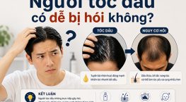 Người tóc dầu có dễ bị hói không? Chuyên gia giải đáp từ A-Z