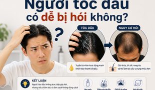 Người tóc dầu có dễ bị hói không? Chuyên gia giải đáp từ A-Z