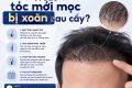 Vì sao tóc mới mọc bị xoăn sau cấy?