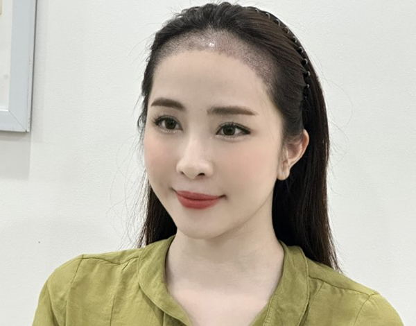 Vì sao tóc mới mọc bị xoăn sau cấy